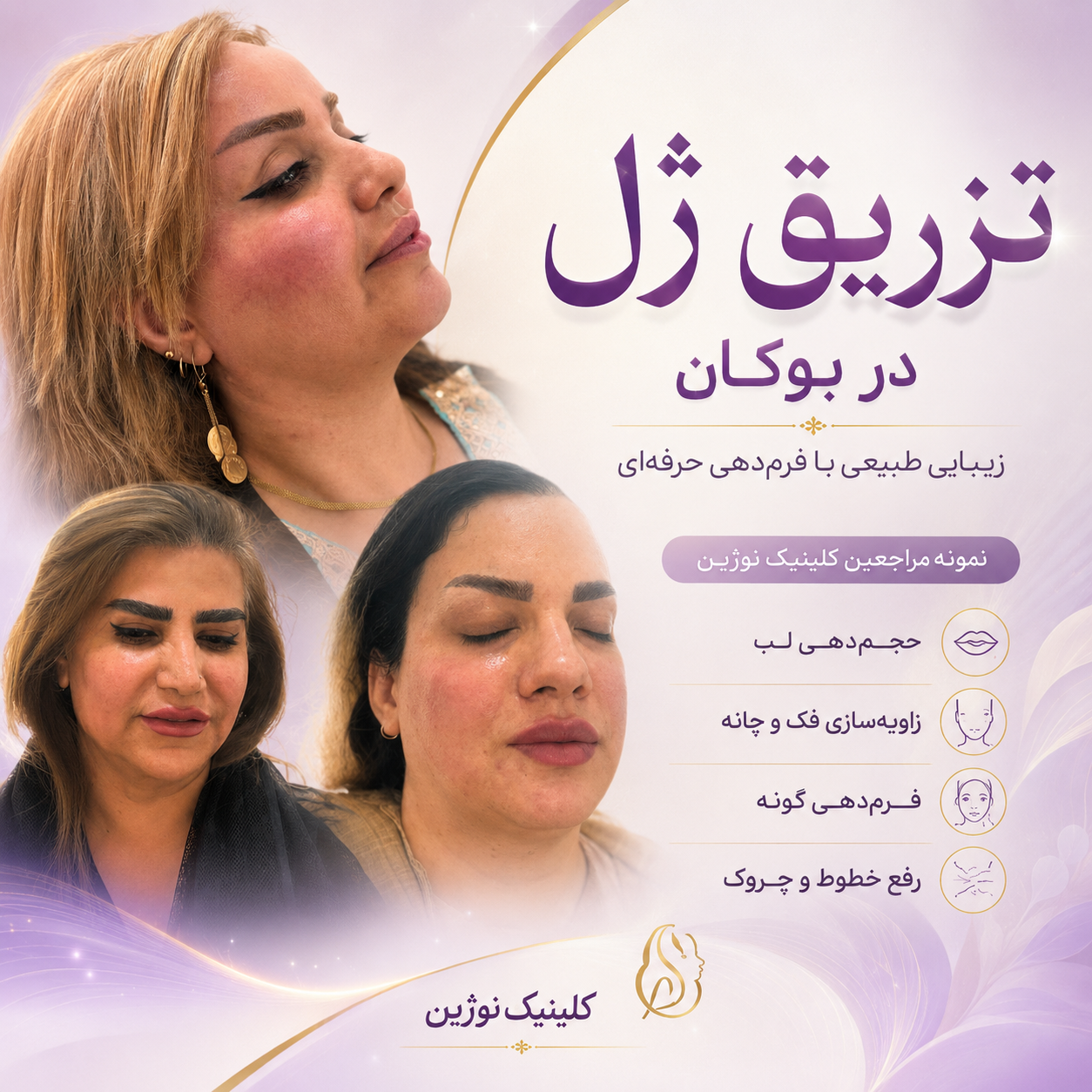 تزریق ژل در بوکان