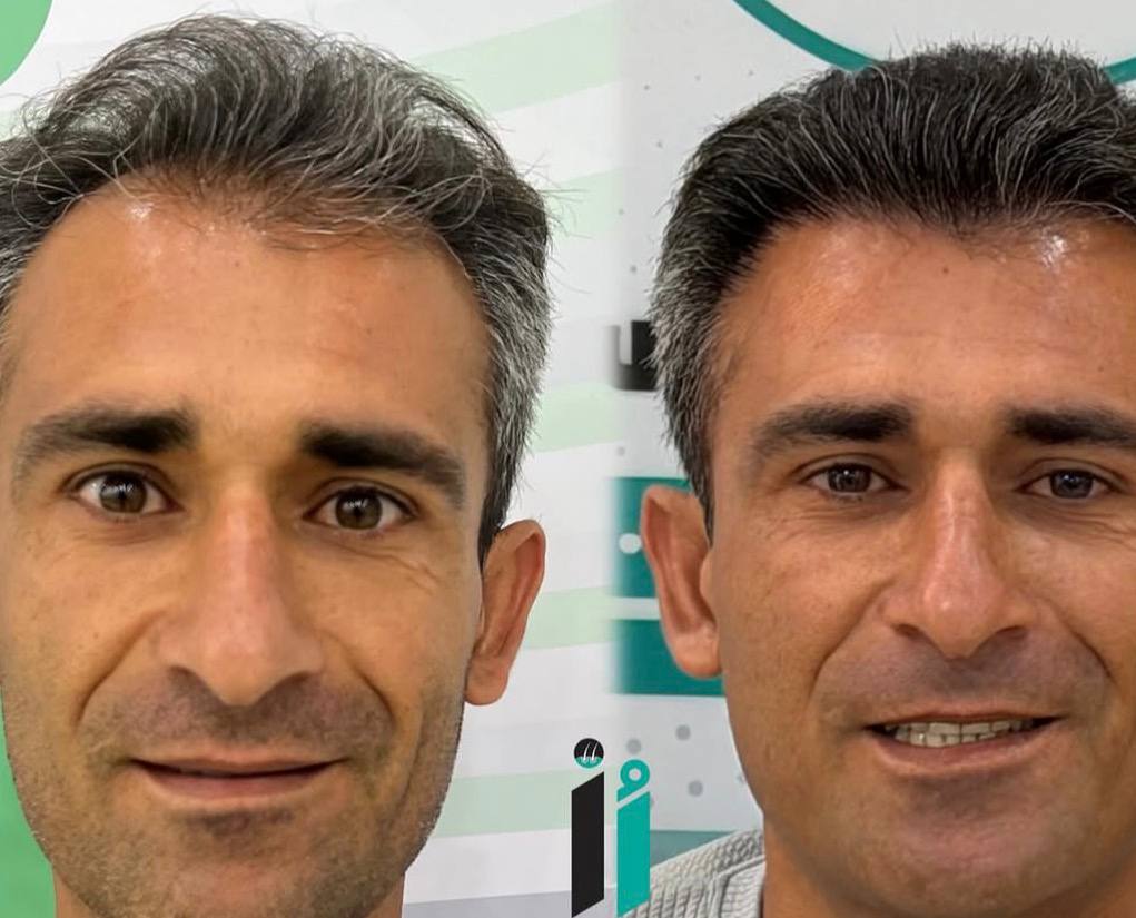 کاشت مو برای مراجعان شاهین‌دژ در کلینیک نوژین
