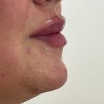 تزریق به روش روسی