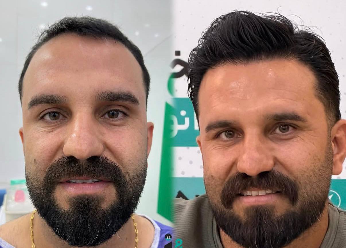 نمونه قبل و بعد کاشت مو برای مراجعان شاهین‌دژ