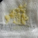 بایوفیلر (biofiller) یا پلاسماژل