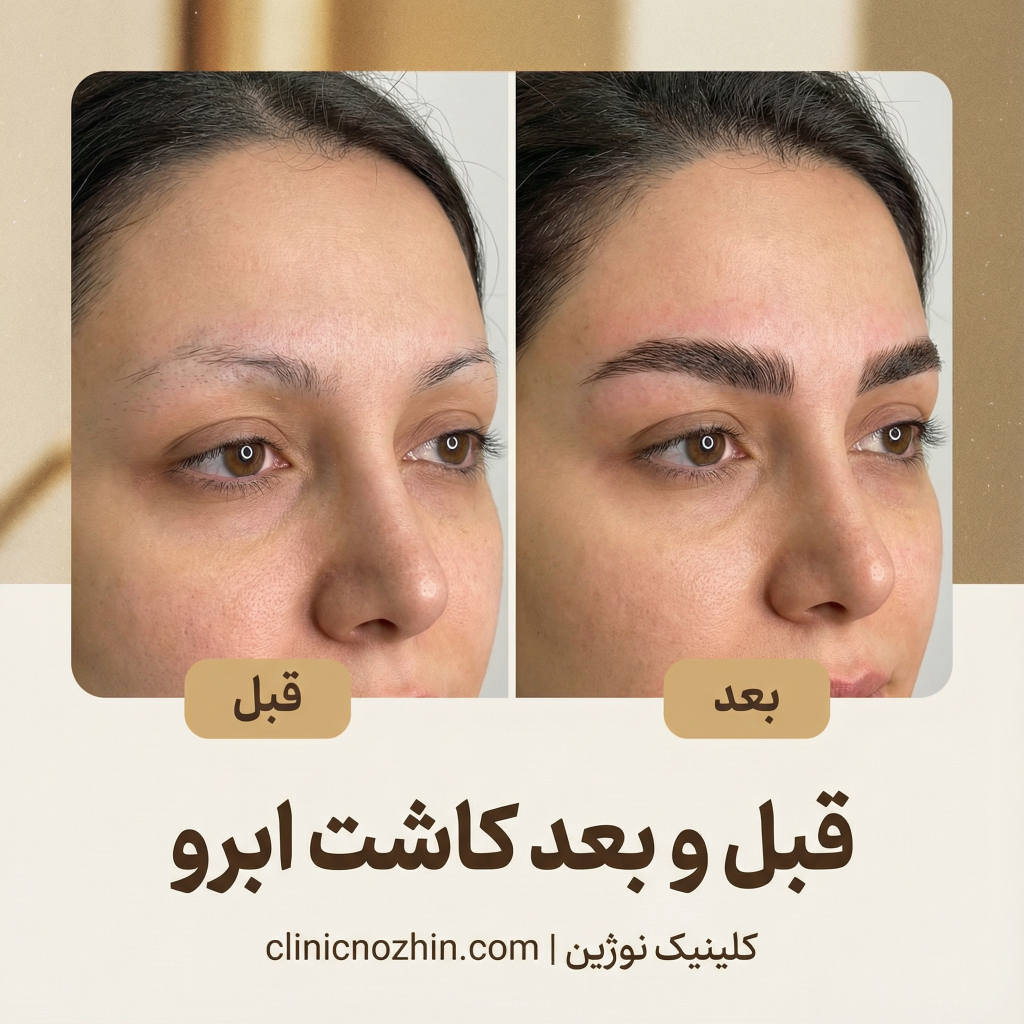 کاشت ابرو طبیعی