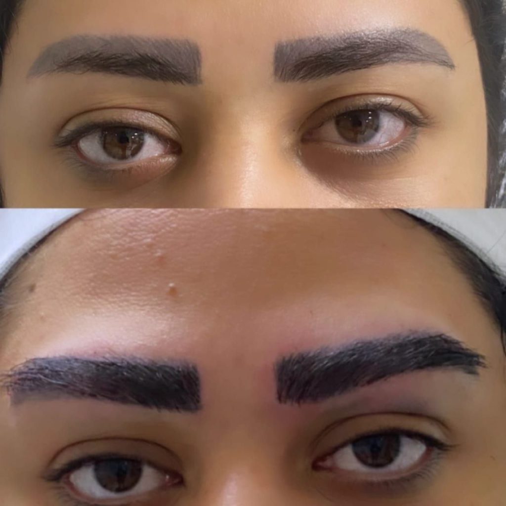 قبل و بعد از کاشت مو ابرو با روش fut