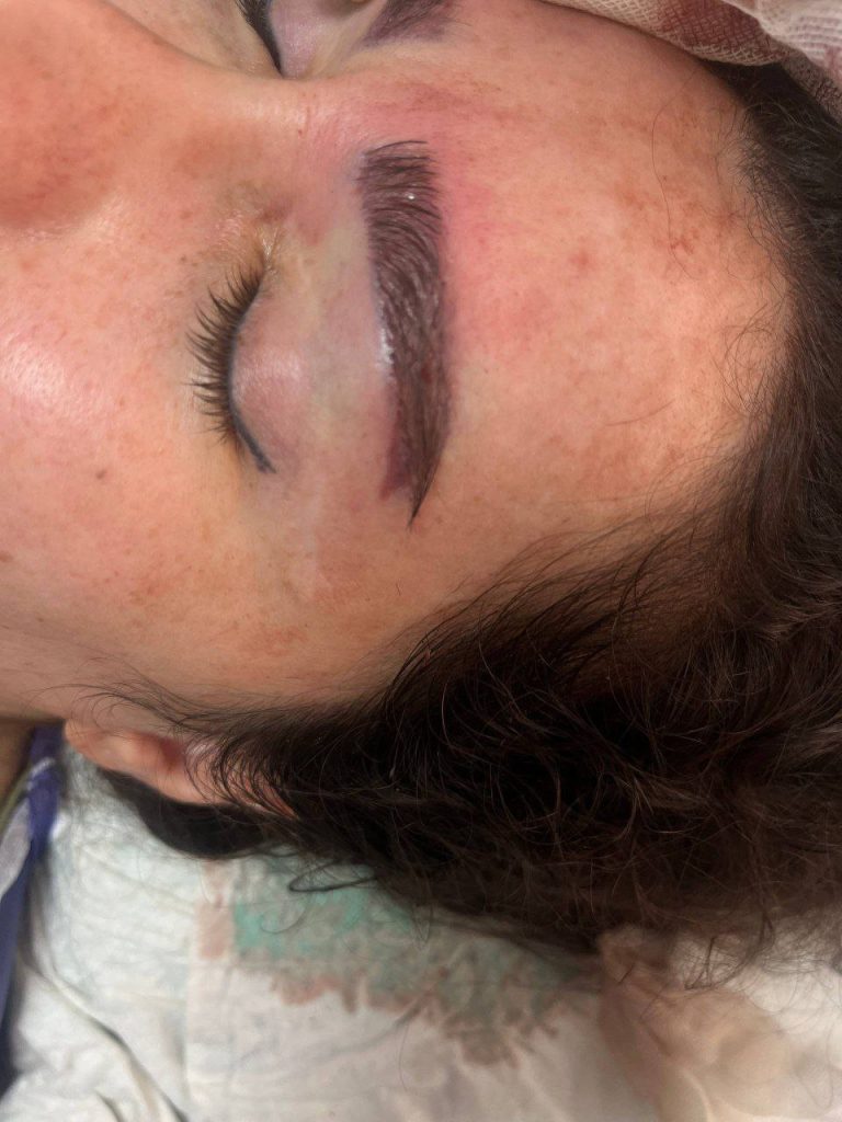 نمونه قبل و بعد کاشت ابرو در تهران