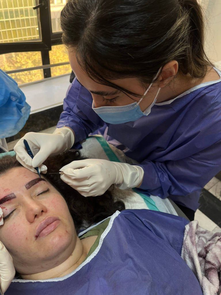 کاشت ابرو به روش FIT