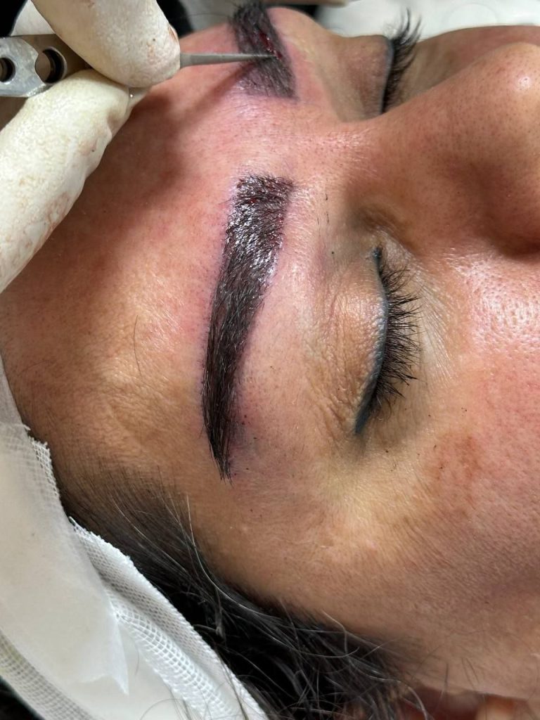 عکس بعد از کاشت مو با روش fut