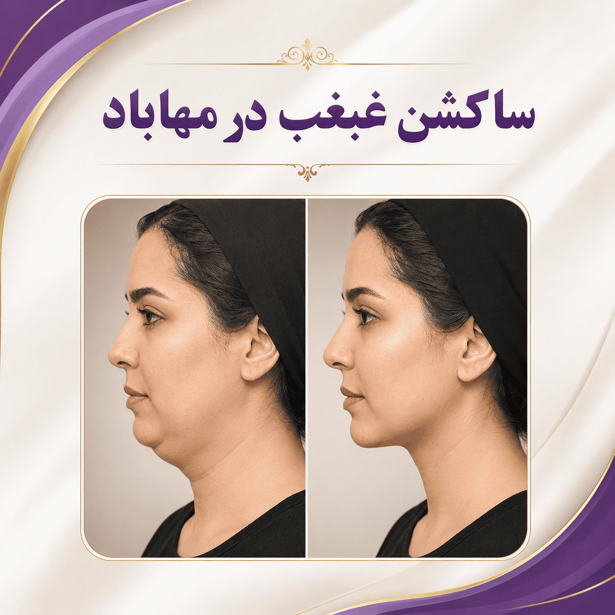 ساکشن غبغب در مهاباد و فرم‌دهی خط فک در کلینیک نوژین