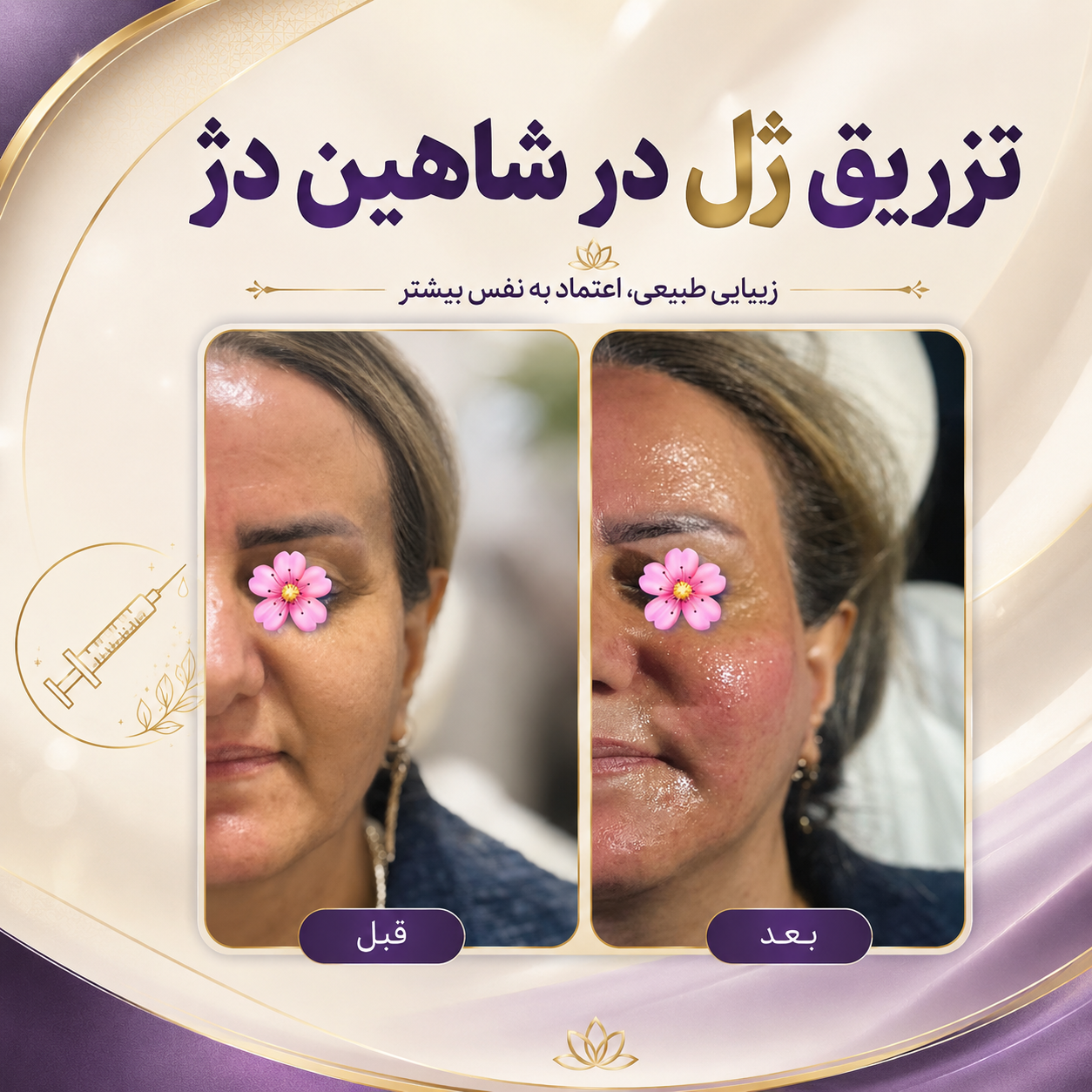 تزریق ژل در شاهین‌دژ برای فرم‌دهی لب، گونه و چانه