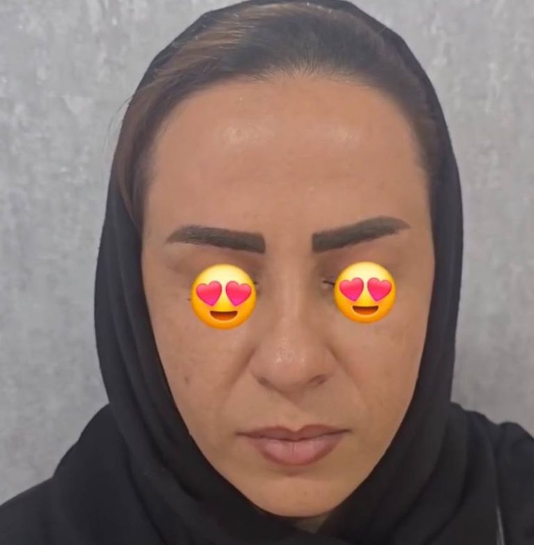 تزریق بوتاکس