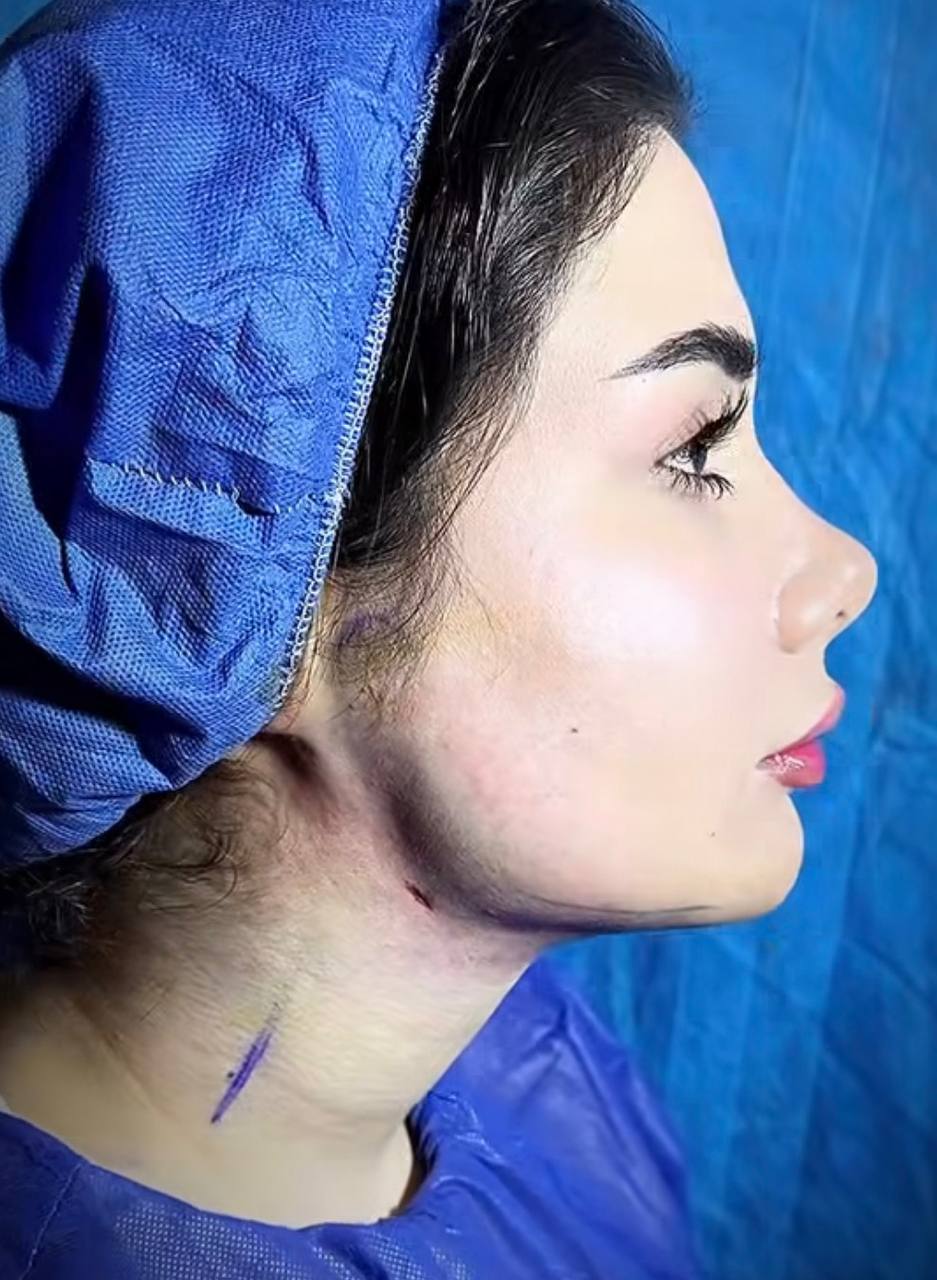 نتیجه بعد از ساکشن غبغب