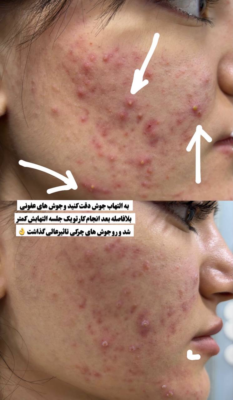پاکسازی و مراقبت از پوست مستعد جوش در سقز