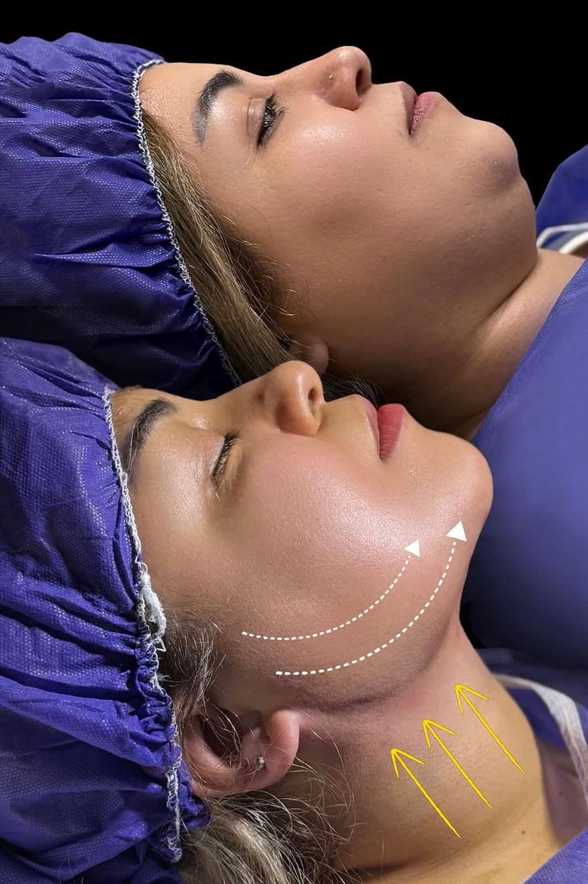 ساکشن غبغب در شاهین‌دژ برای کاهش چربی زیر چانه و فرم‌دهی خط فک