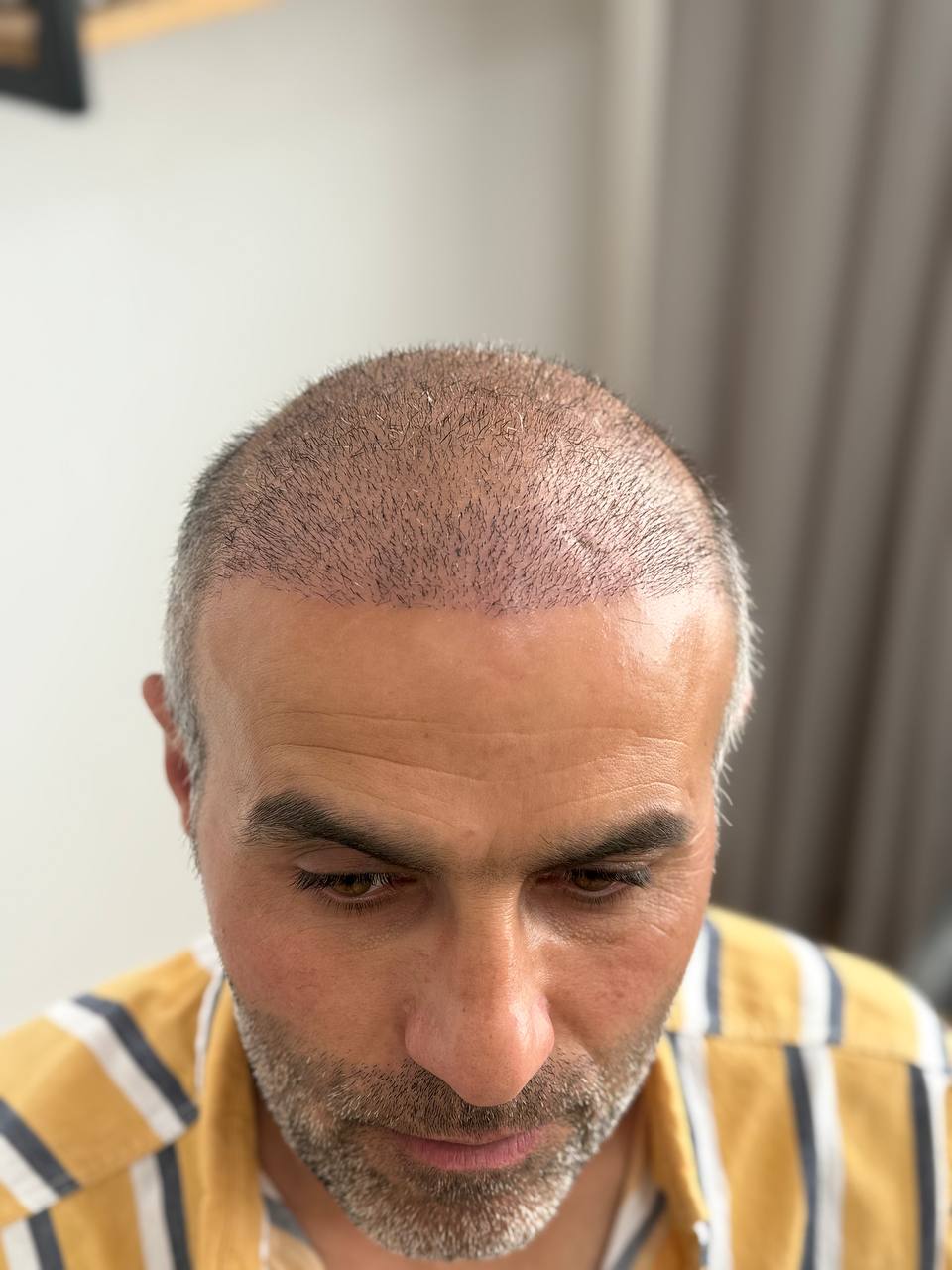 نتیجه کاشت مو بعد از یک ماه