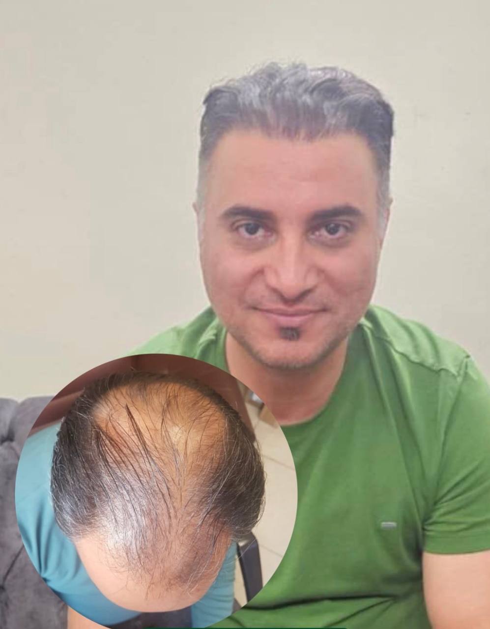مقایسه قبل و بعد کاشت مو