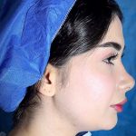 ساکشن غبغب