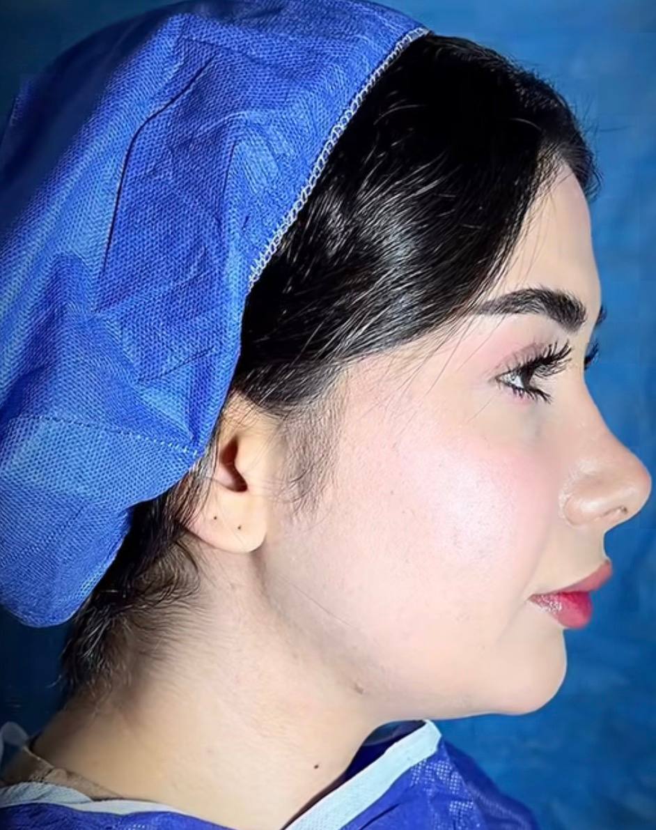تصویر قبل از ساکشن غبغب