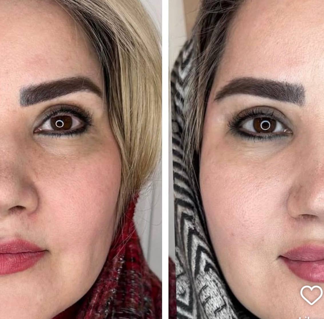 نمونه قبل و بعد تزریق ژل شقیقه در کلینیک نوژین