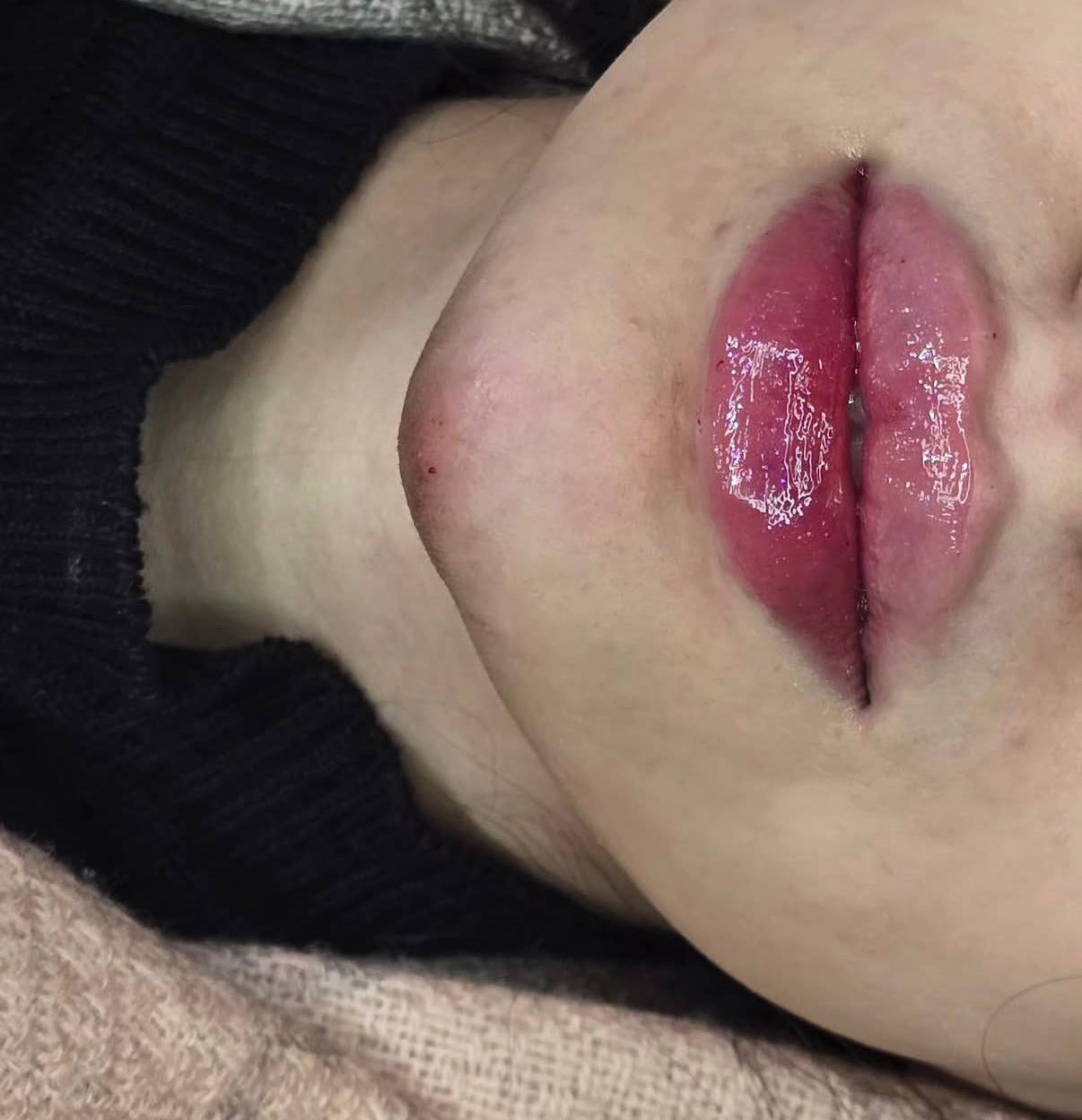 نمونه قبل و بعد تزریق ژل لب در کلینیک نوژین