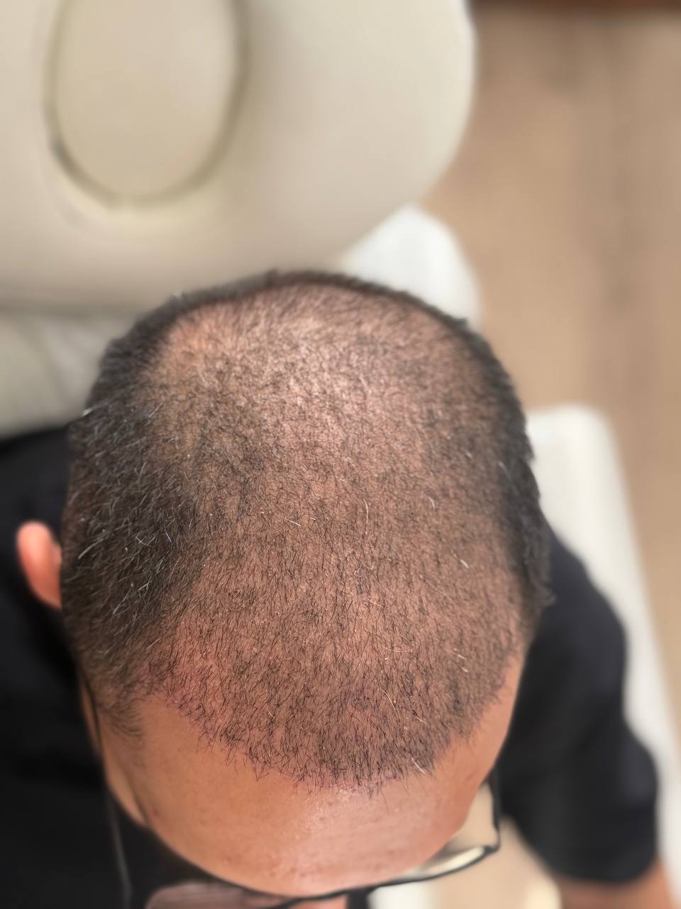 بلافاصله بعد از کاشت مو
