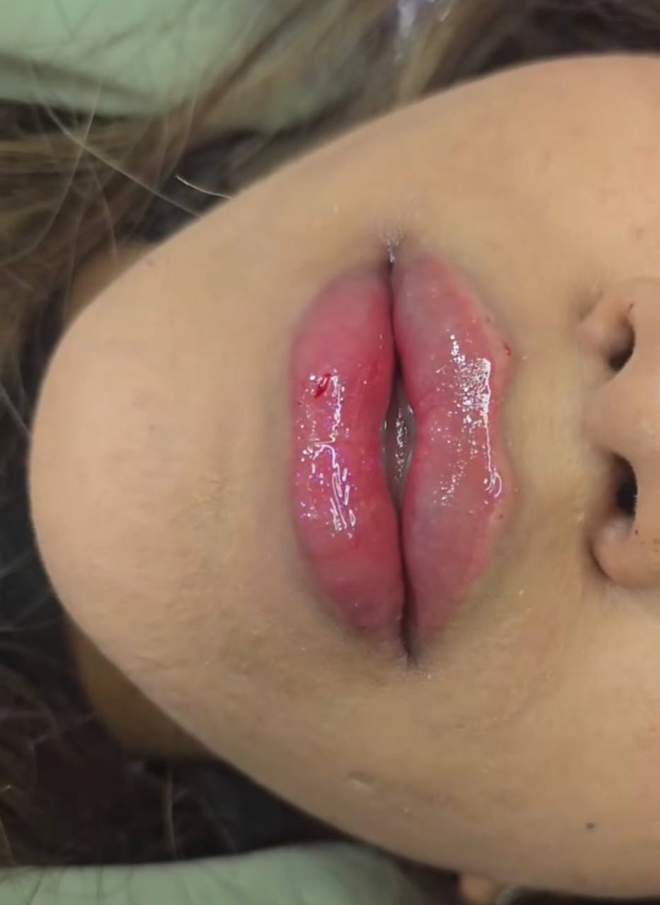 نمونه فرم‌دهی و افزایش حجم لب با تزریق ژل