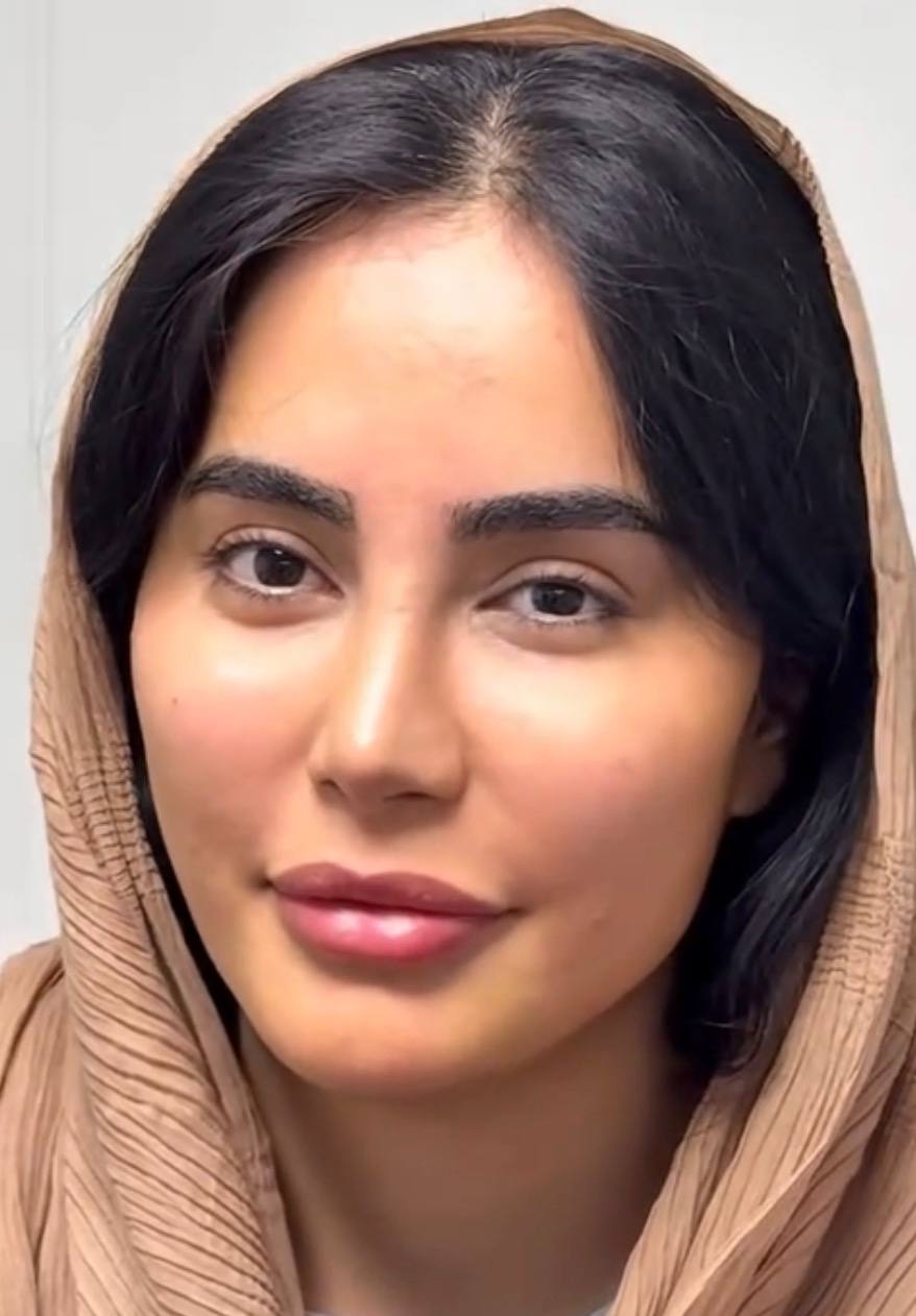 بعد از تزریق چربی صورت - نمونه کار دوم