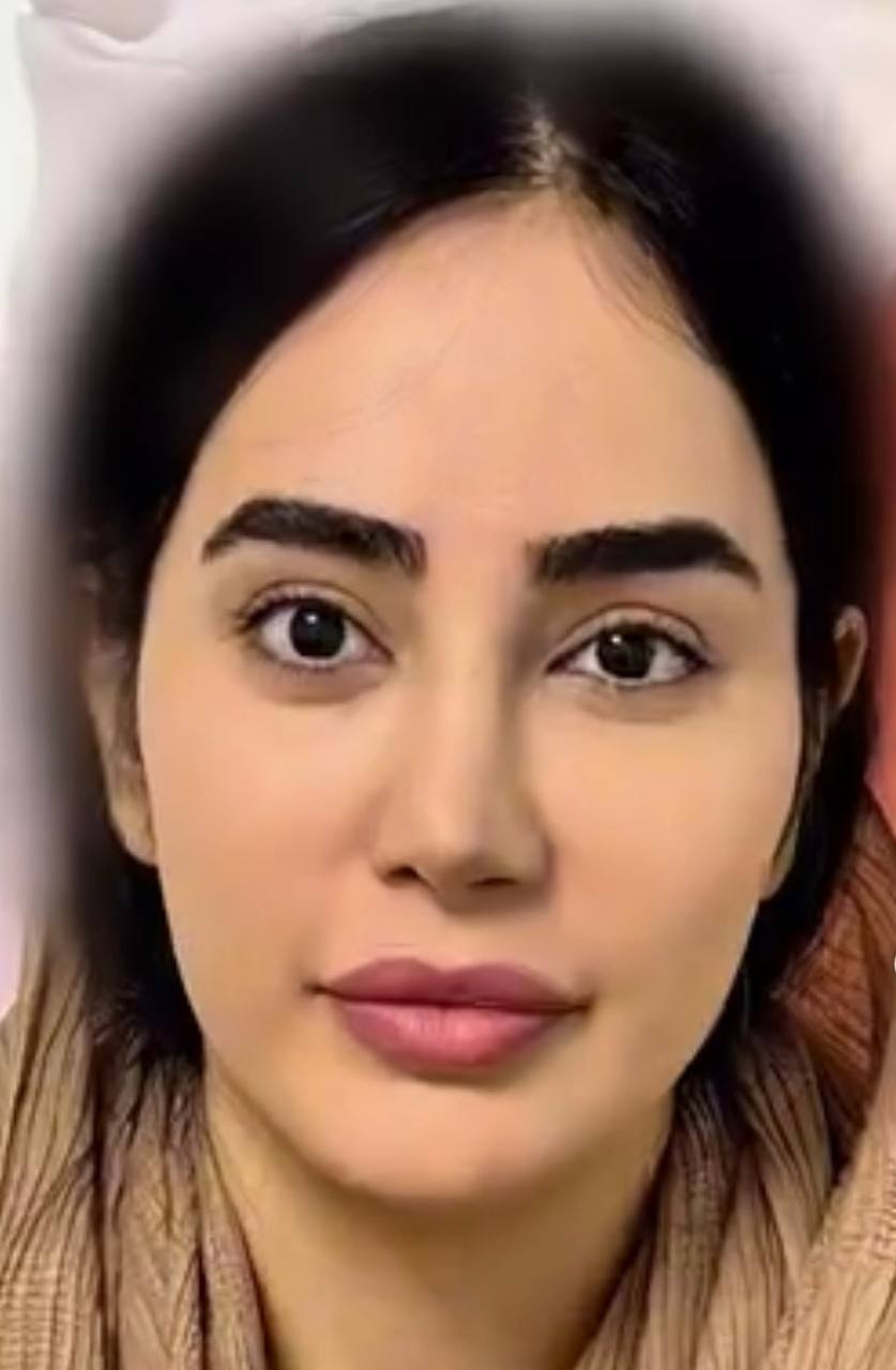 قبل از تزریق چربی صورت - نمونه کار دوم