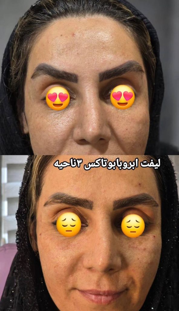 تزریق بوتاکس