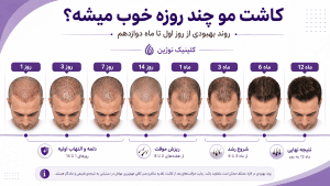 کاشت مو چند روزه خوب میشه؟