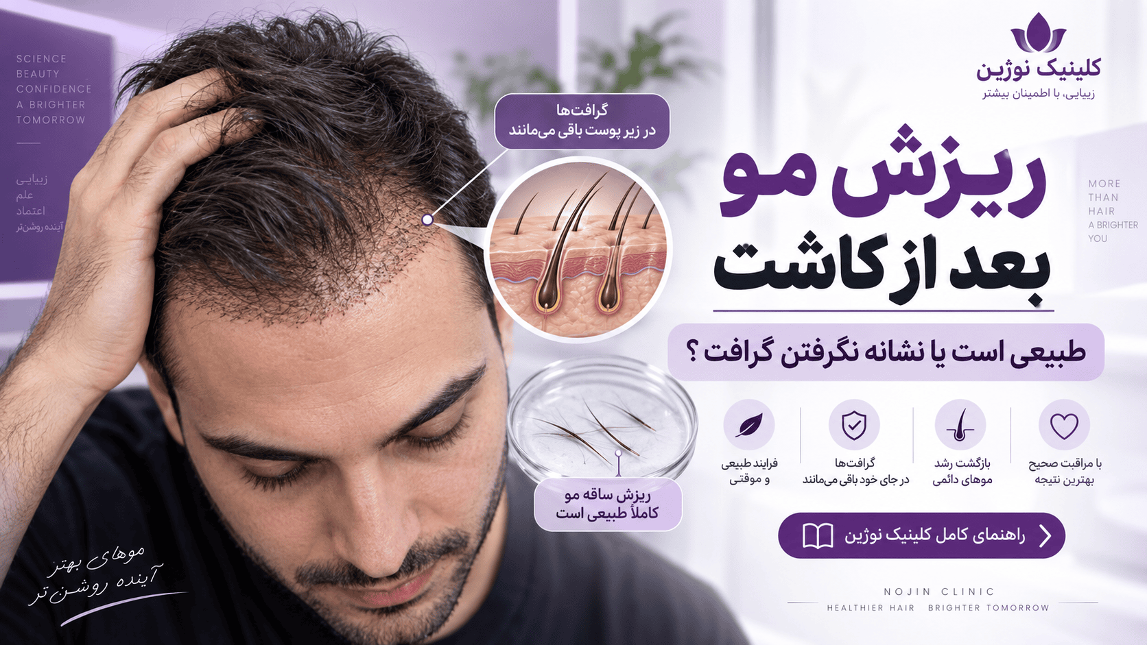 ریزش مو بعد از کاشت و نگرانی درباره نگرفتن گرافت